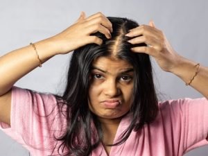 Alopecia androgenética com especialista em São Paulo
