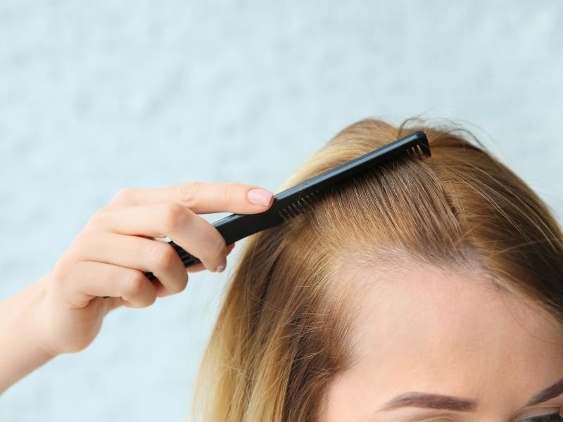 Alopecia feminina em São Paulo