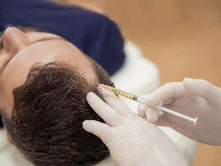 Alopecia masculina com especialista em São Paulo