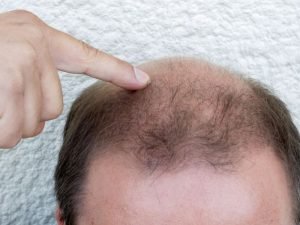 Clínica de alopecia areata em São Paulo