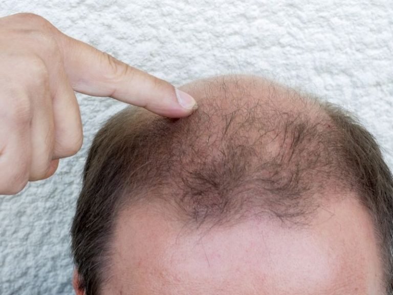 Clínica de alopecia areata em São Paulo