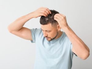 Alopecia frontal fibrosante em São Paulo