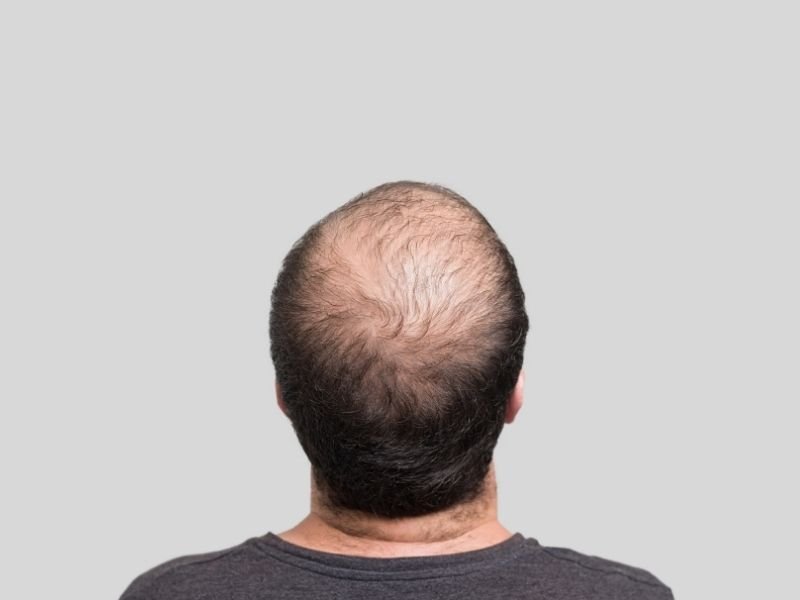 Calvície hereditária em São Paulo