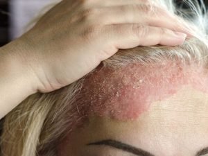 Dermatite seborreica em São Paulo