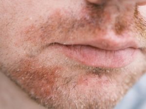 Tratamento de dermatite seborreica em São Paulo