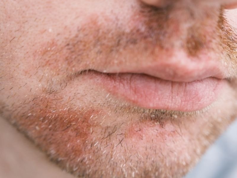 Tratamento de dermatite seborreica em São Paulo