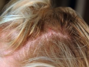 Dermatite seborreica com especialista em São Paulo
