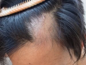 Queda acentuada de cabelo em São Paulo