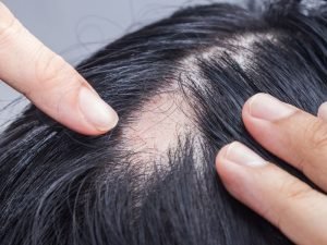 Clínica que trata alopecia em São Paulo