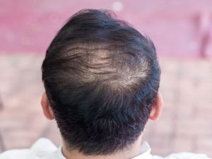 Pós-COVID queda de cabelo com especialista em São Paulo