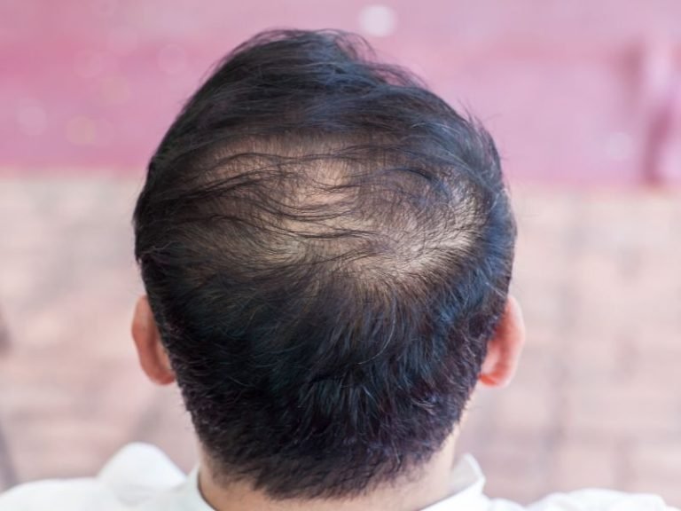 Pós-COVID queda de cabelo com especialista em São Paulo