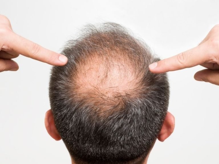 Tricologista para homens em São Paulo