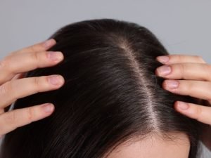Especialista em alopecia areata em São Paulo