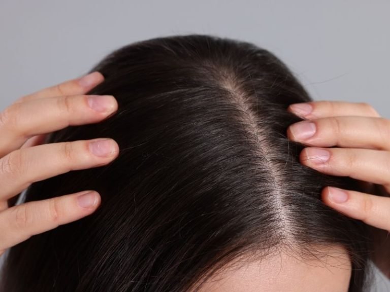 Especialista em alopecia areata em São Paulo