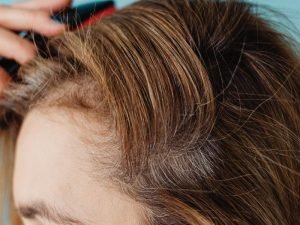 Especialista em alopecia frontal fibrosante em São Paulo